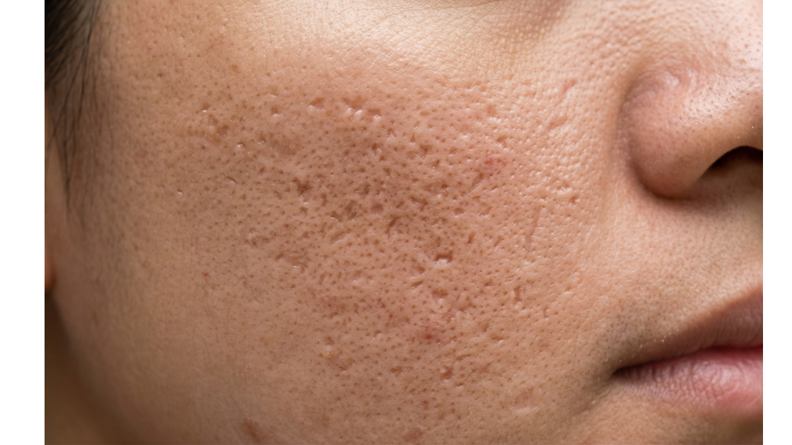 Acne scars & post-inflammatory marks