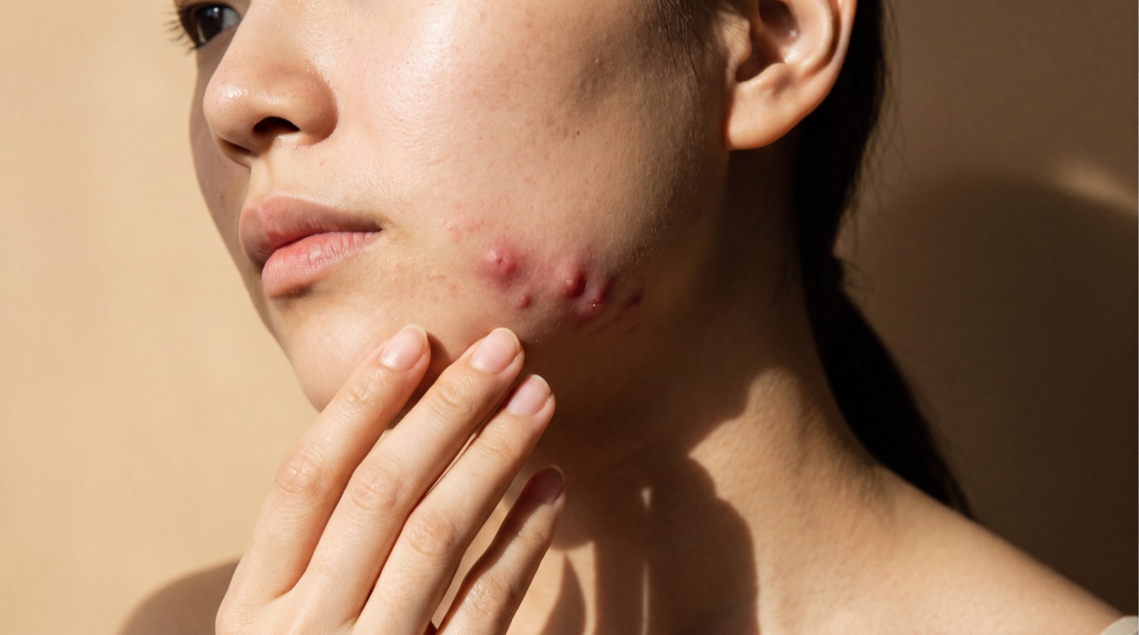Close-up of a woman's jawline with a few deep, red, tender breakouts