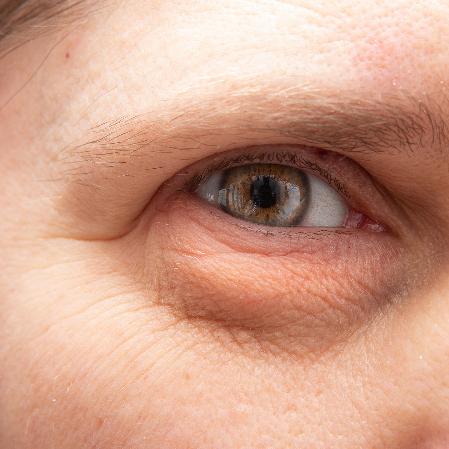 Brow Ptosis