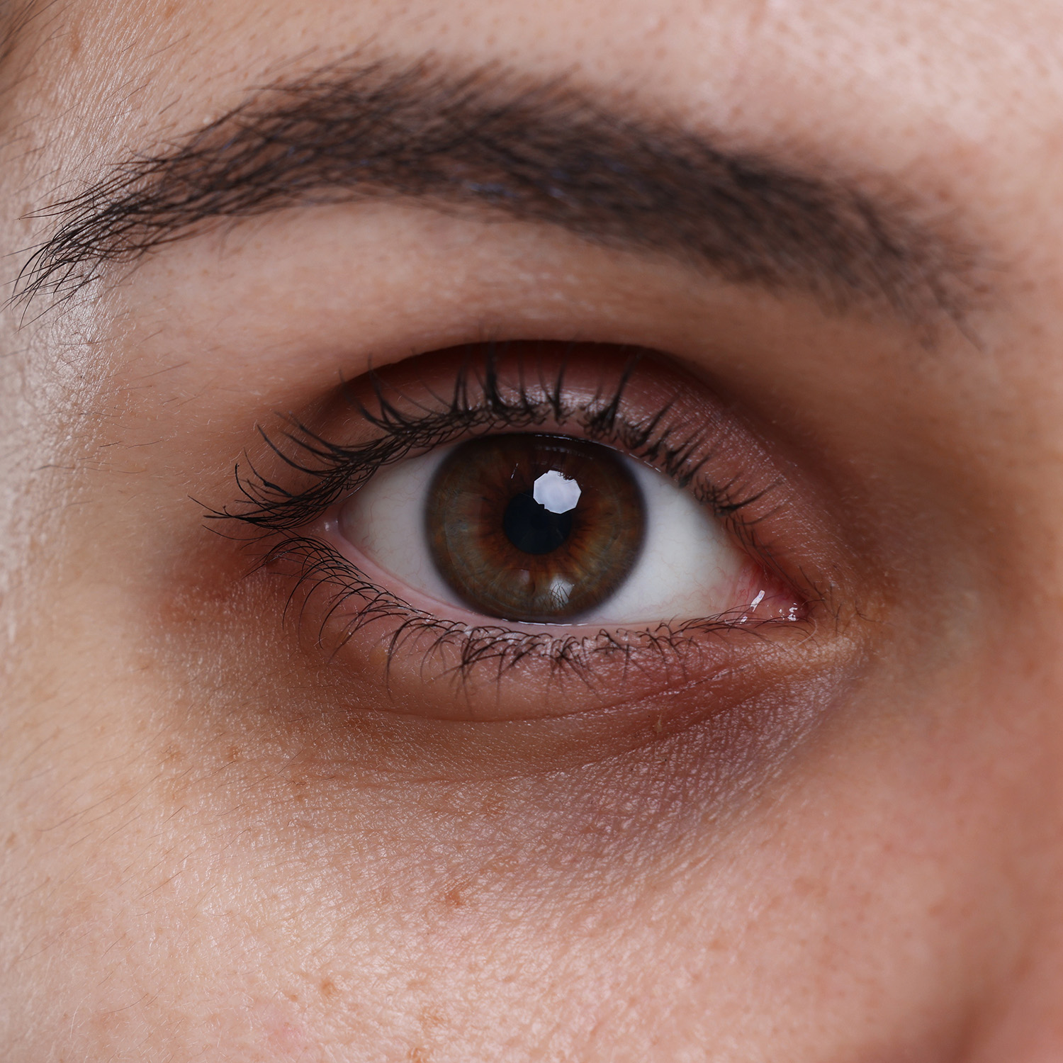 Dark eye circles