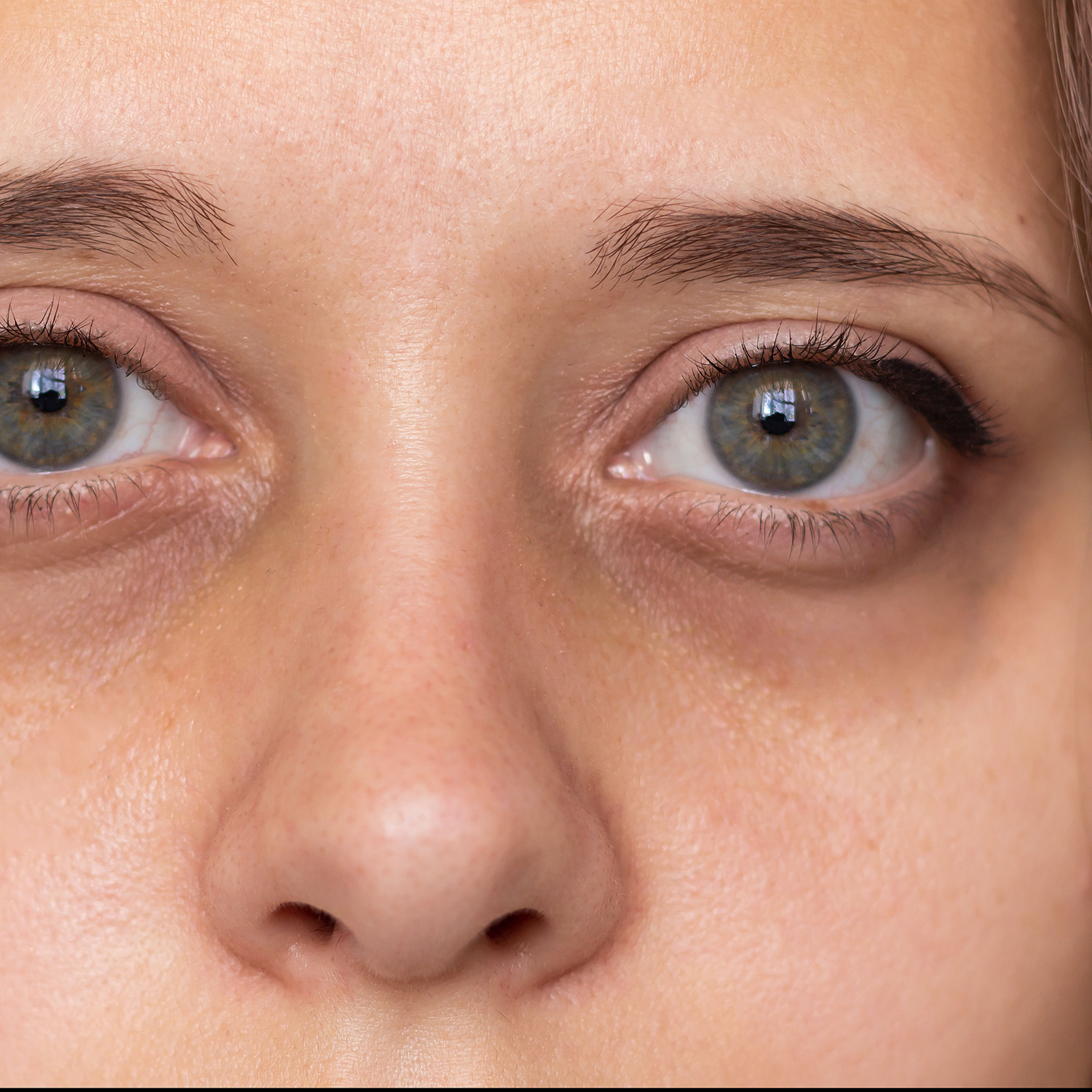 Dark eye circles