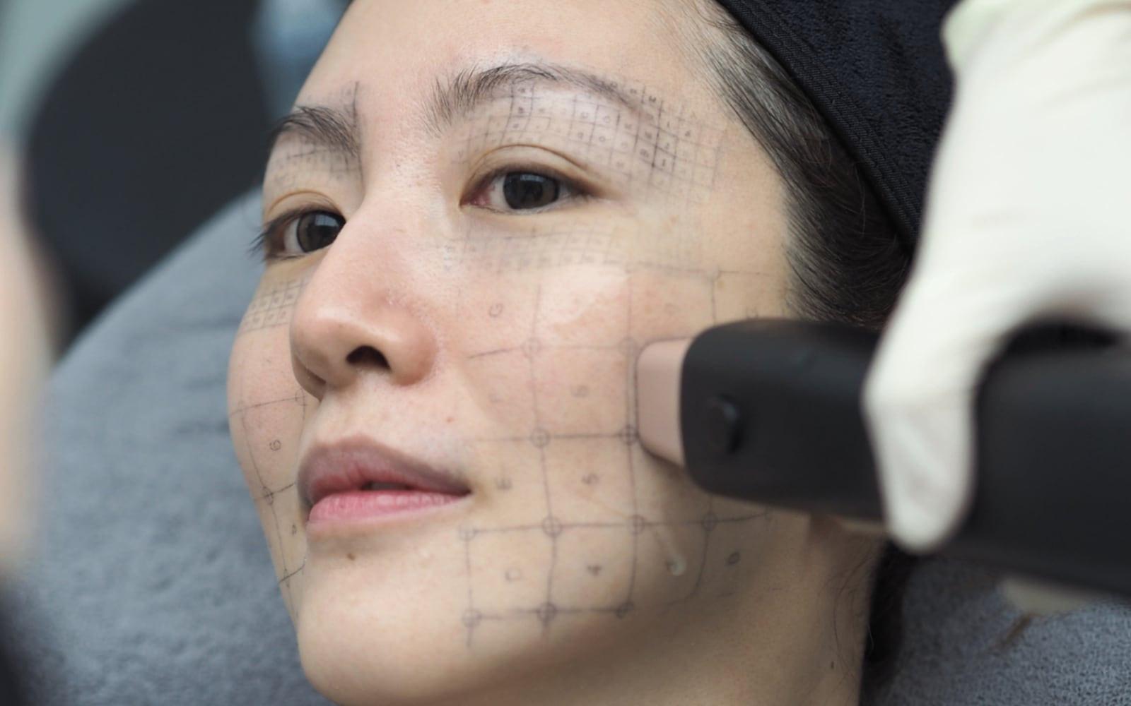 Patient with treatment grid markings receiving a Density RF session on the cheek