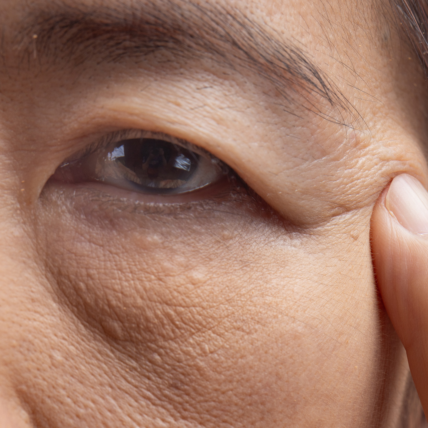 Under-eye hollowness