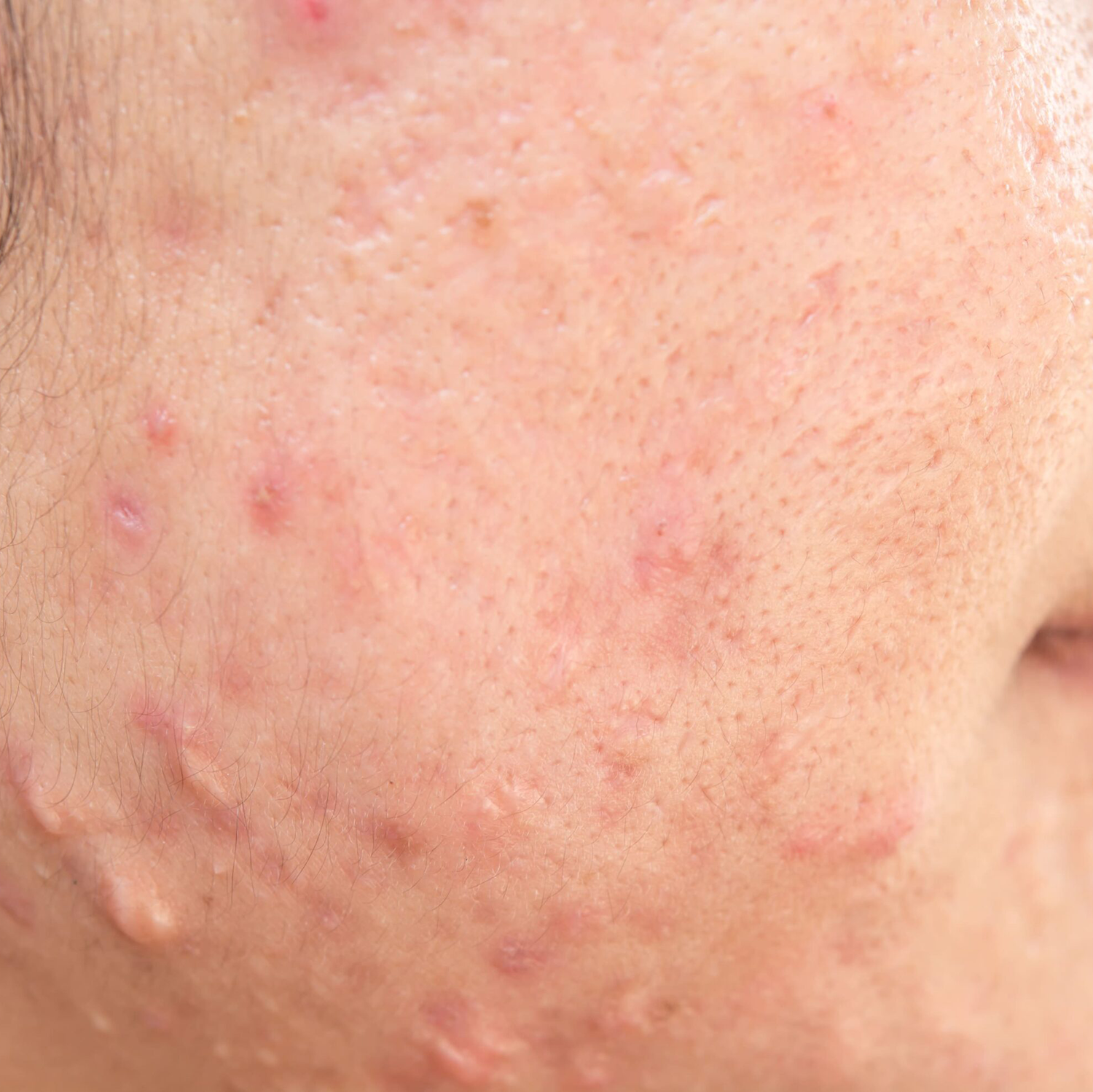 Post-acne marks & dullness