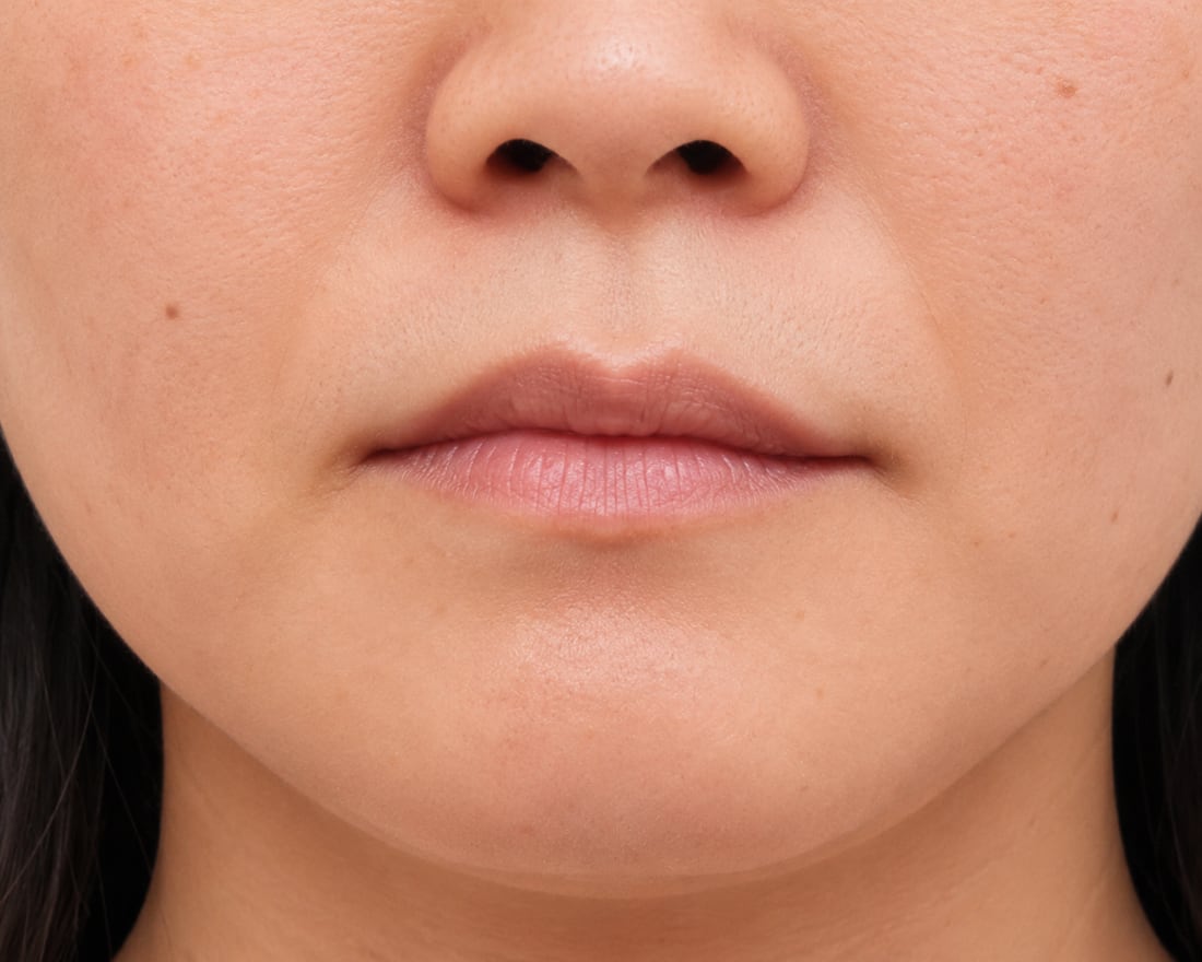 Uneven lip shape or asymmetry