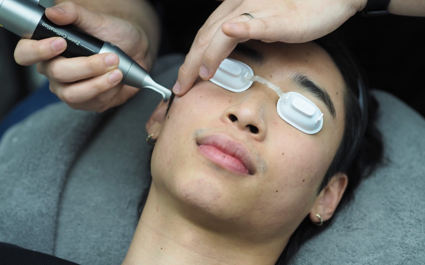 Patient receiving a laser treatment to the face with protective eyewear at Reborn Skin Clinic
