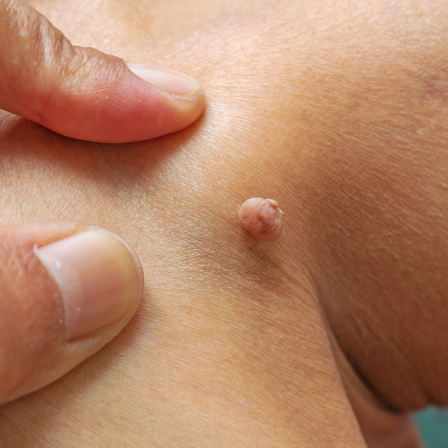 Skin tags