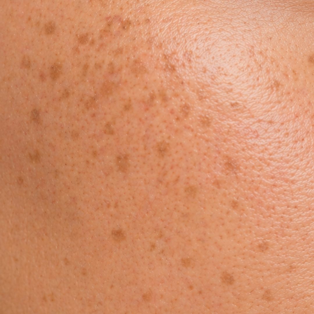 Pigmentation