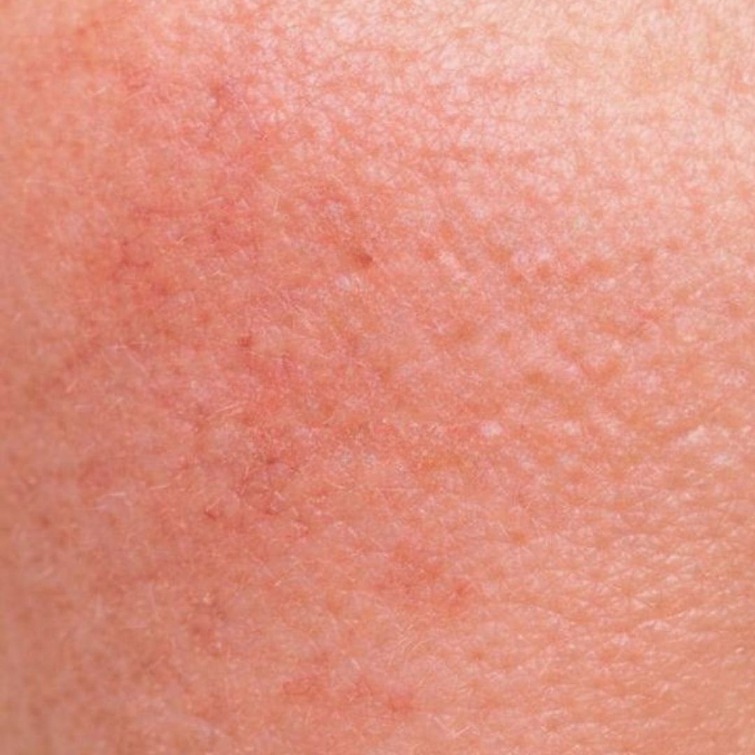 Sensitive Skin
