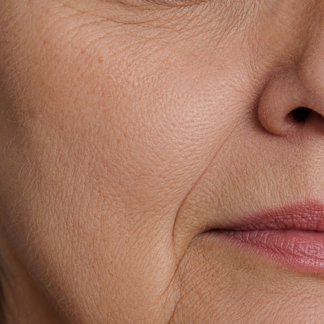 Skin Laxity