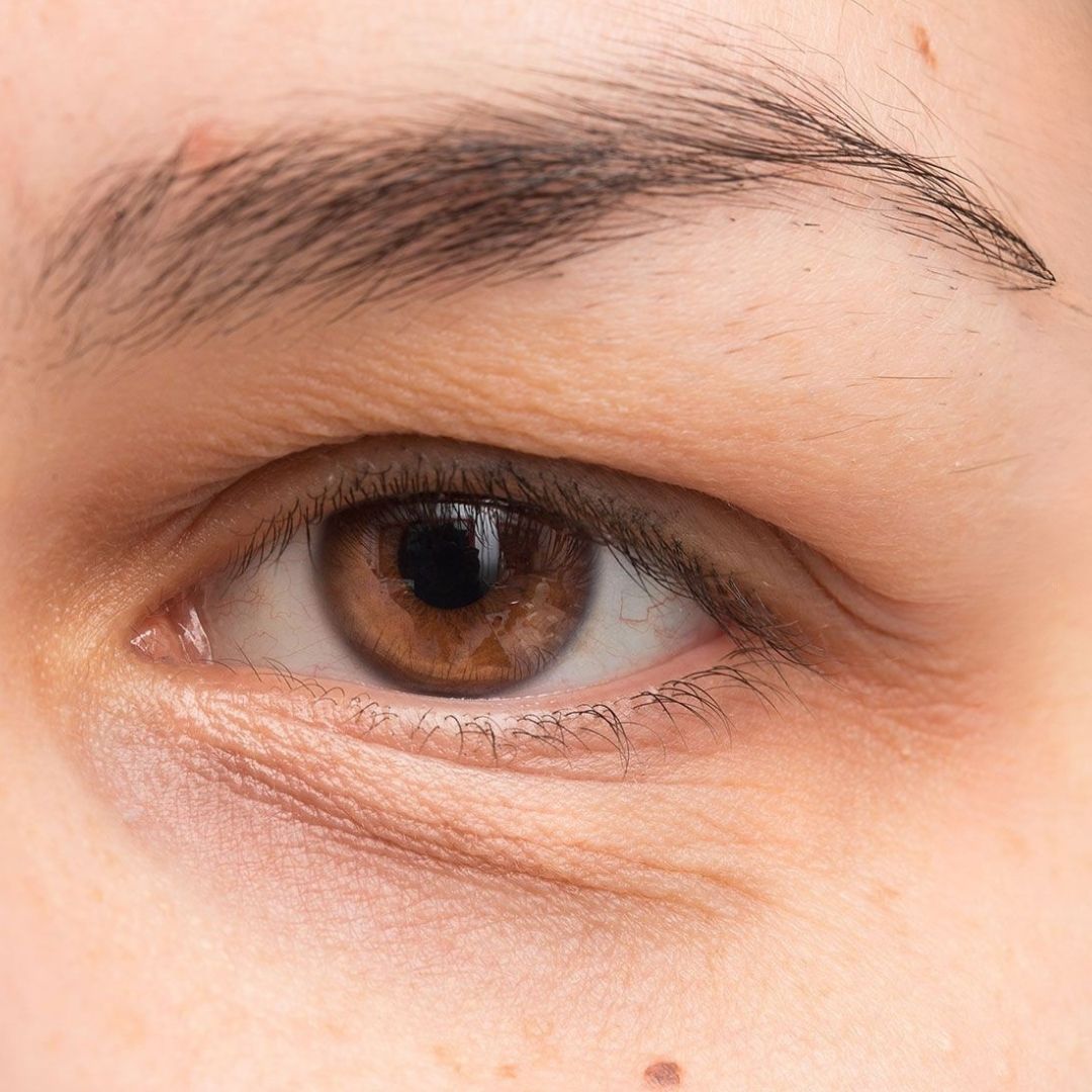 Droopy Eyelids
