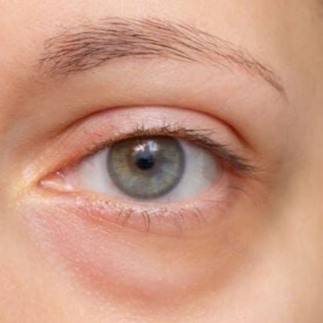 Eye Bags