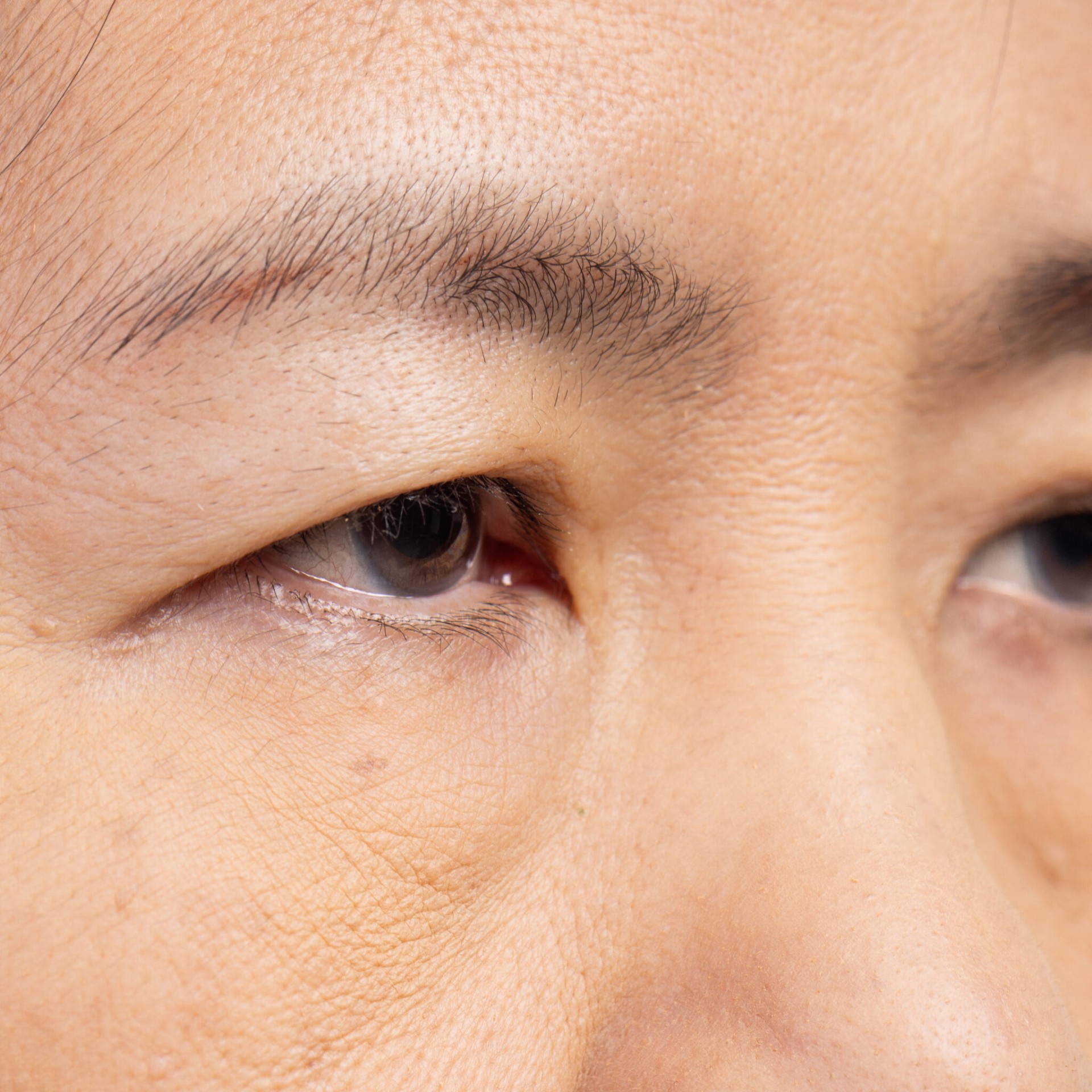 True Ptosis
